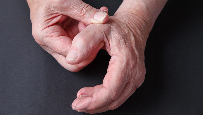 patient holding his thumb in pain due to basal joint arthritis