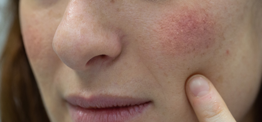 Patient treatment for Saggy skin at Revive Regenerative Medical Group in Newport Beach