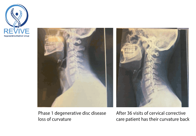 Patient x-ray before and after Corrective Care at Revive Regenerative Medical Group in Newport Beach