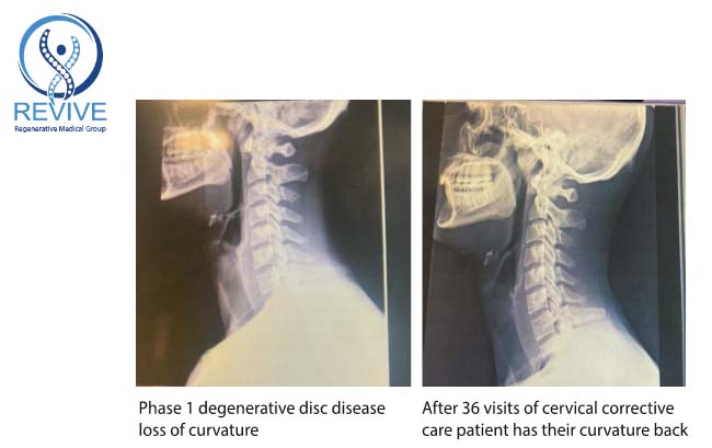 Patient x-ray after corrective care at Revive Regenerative Medical Group in Newport Beach.